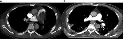 Case report: AngioJet thrombectomy with extracorporeal membrane oxygenation support for acute massive pulmonary embolism in a severe multiple trauma patient